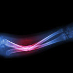 X-ray of a bone fracture X-ray of a bone fracture